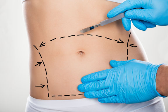 Abdominoplastik Limburg